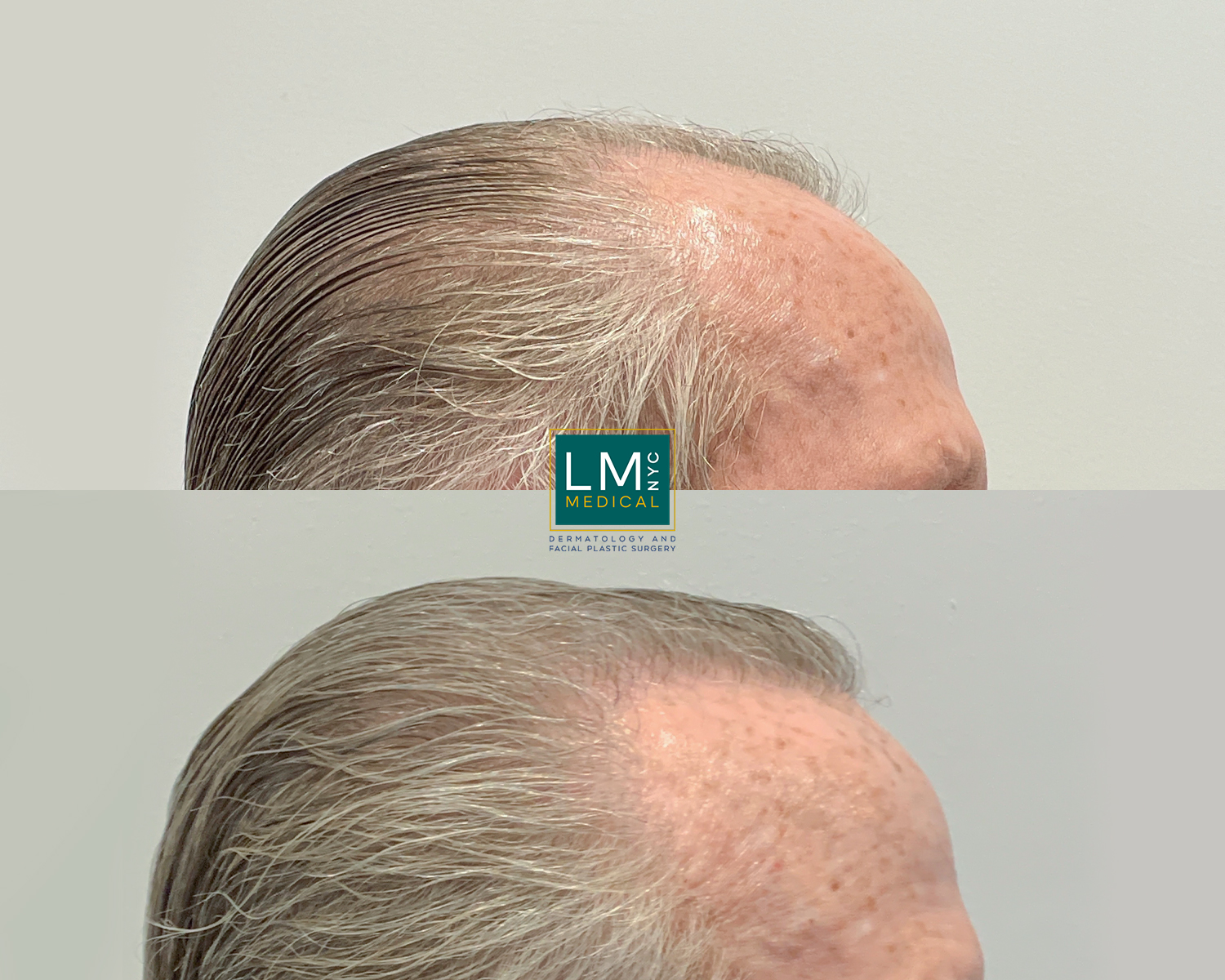 hairtransplant4