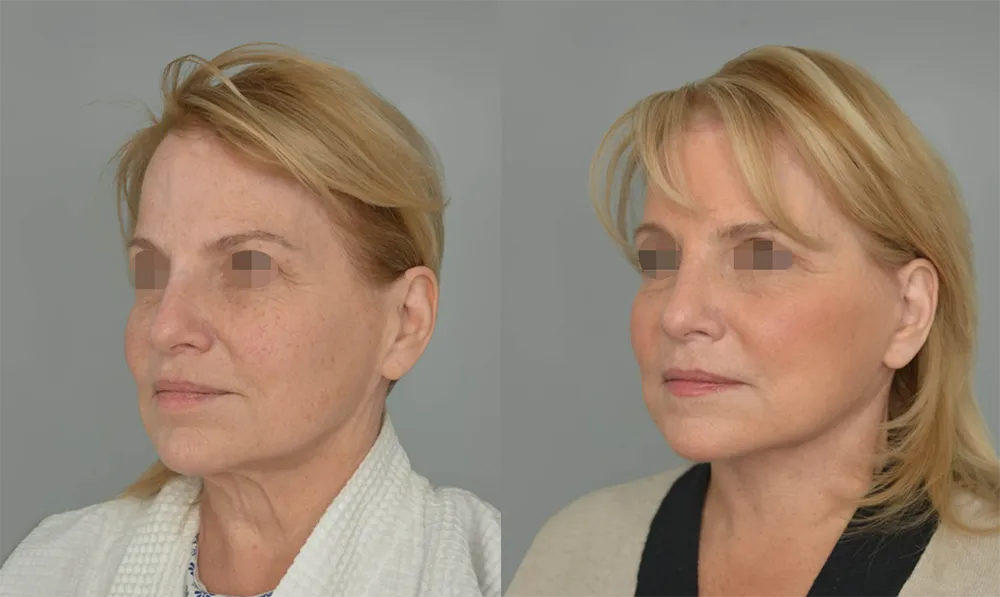 deep-plane-neck-lift