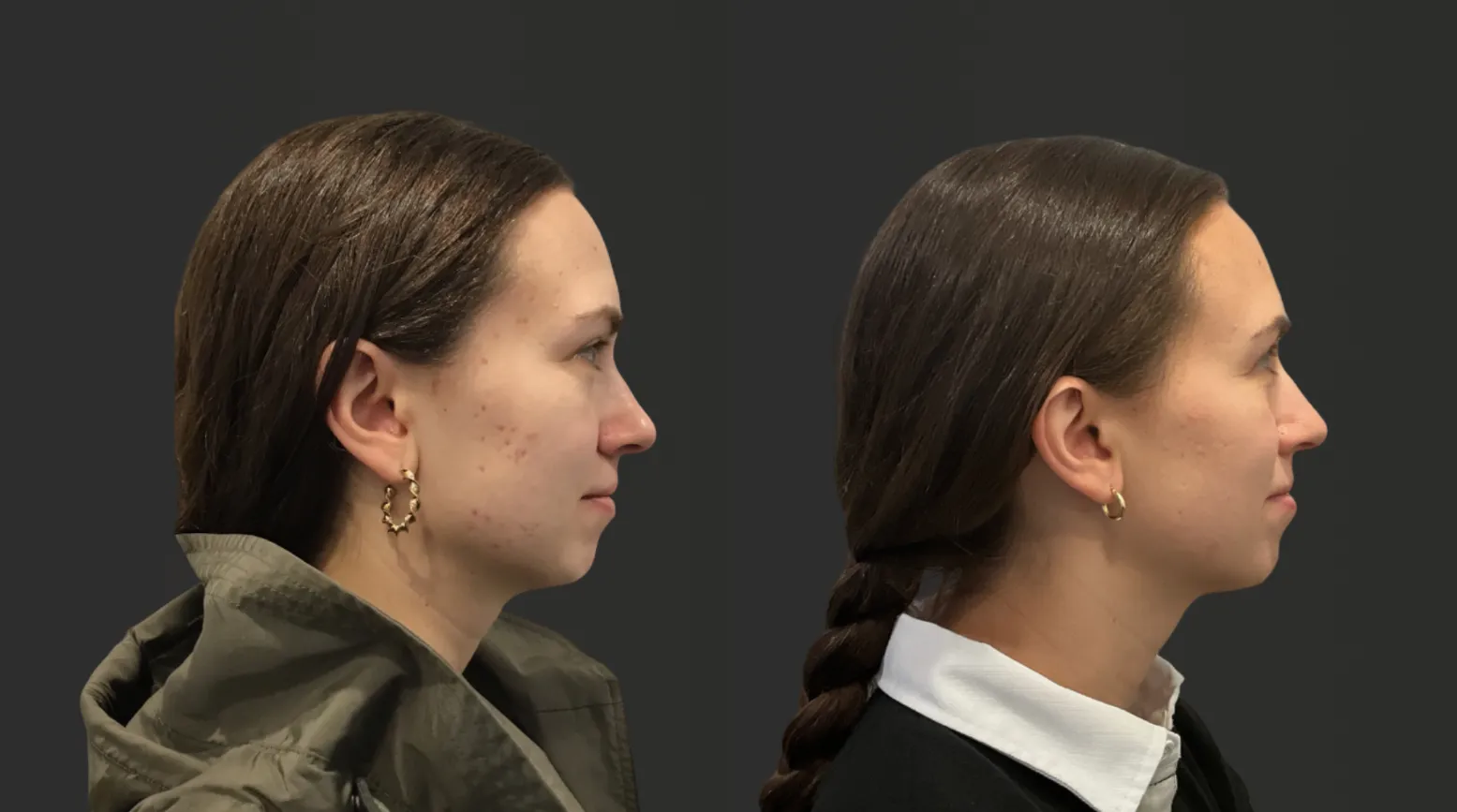 microneedling-spotlight