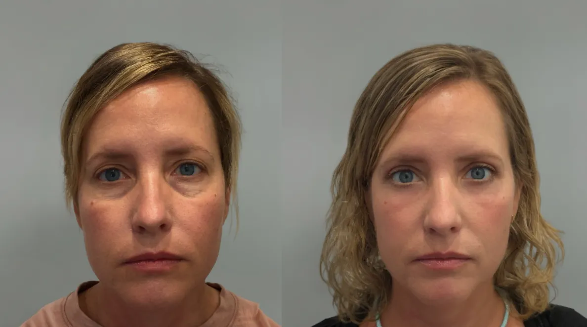 upper-eyelid-spotlight